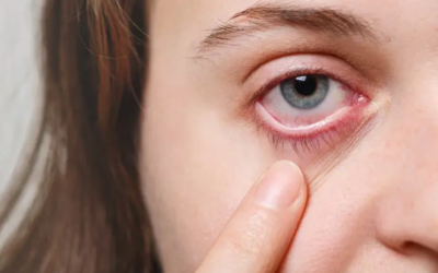 5 Natural Ways To Improve Dry Eyes