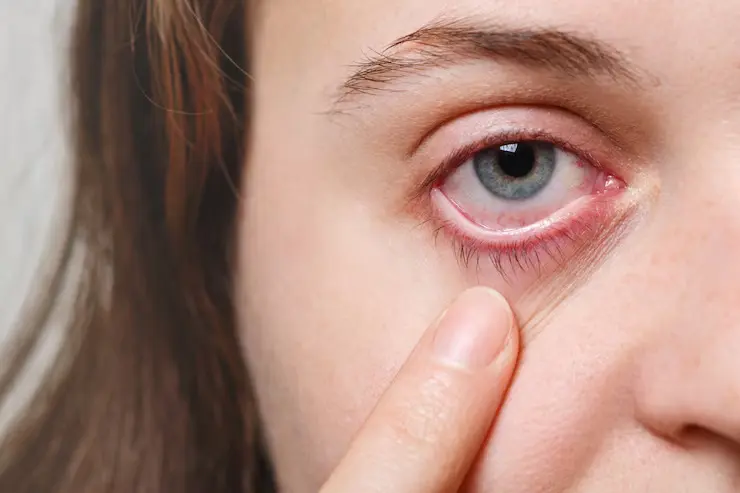 Treatment for dry eyes