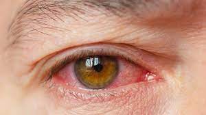 Dry Eyes Or Allergy? Know The Difference