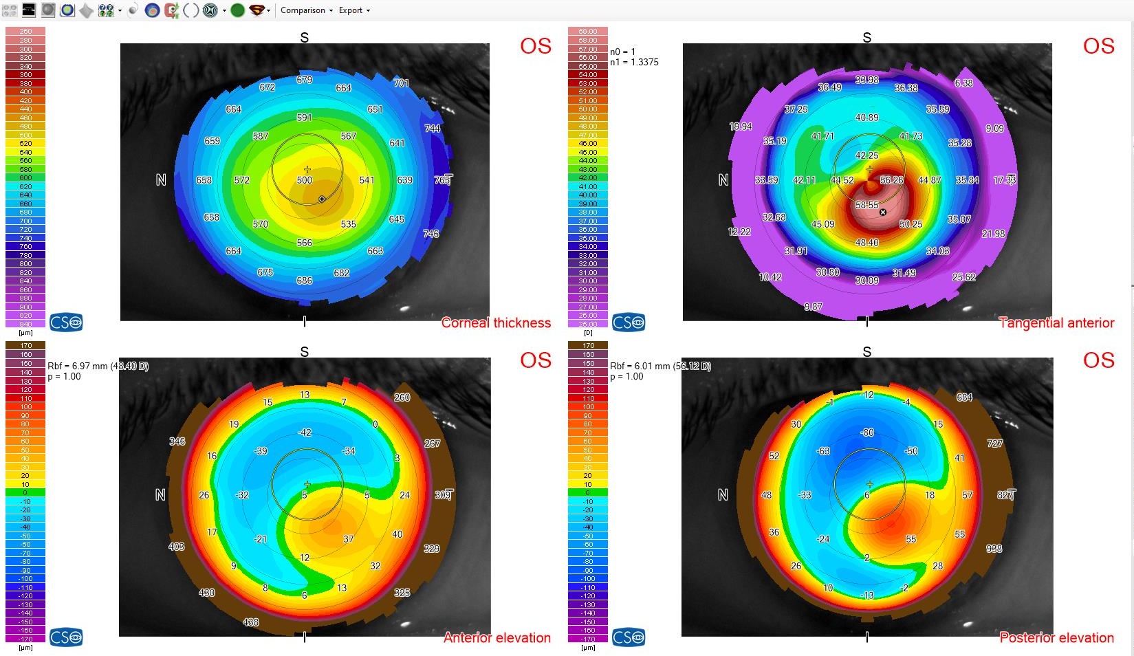 World Keratoconus Day 2022