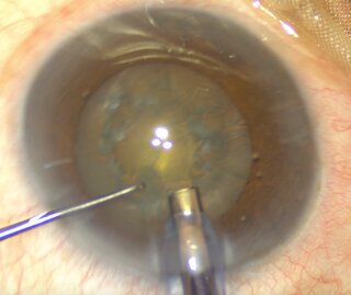 What is Phacoemulsification cataract surgery?